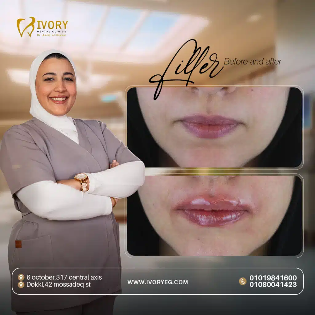 حقن البوتكس والفيلر