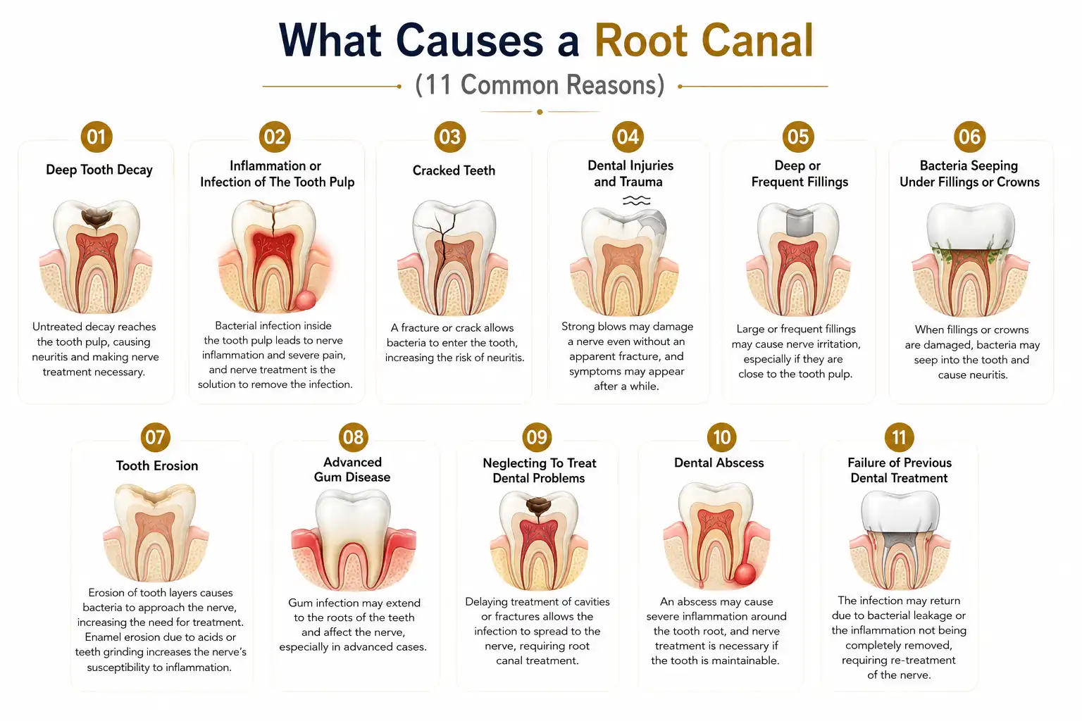 What Causes a Root Canal What Causes a Root Canal
